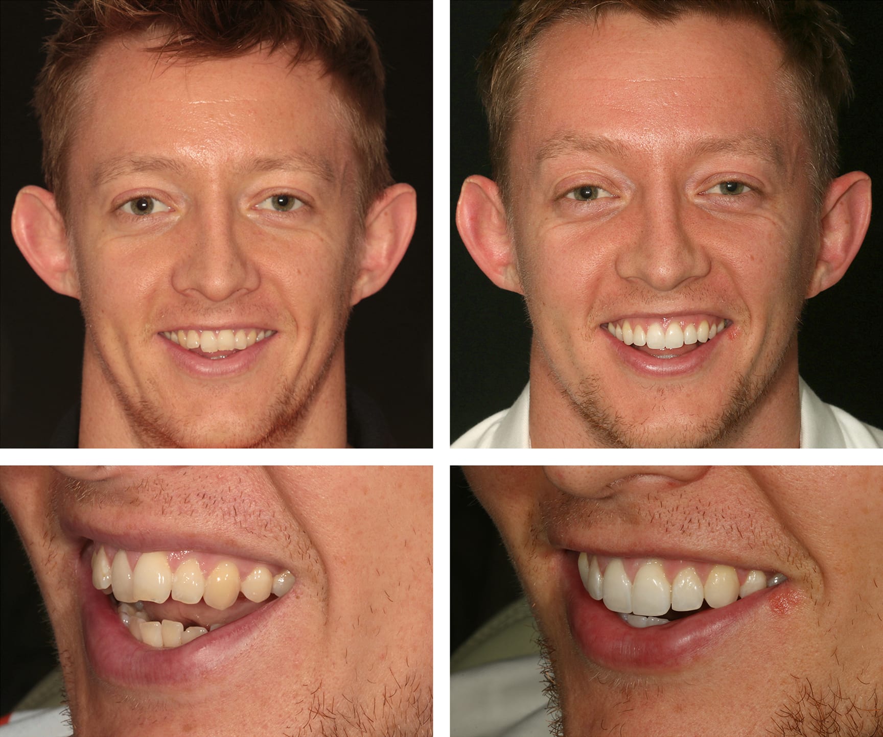 Teeth Whitening - adam