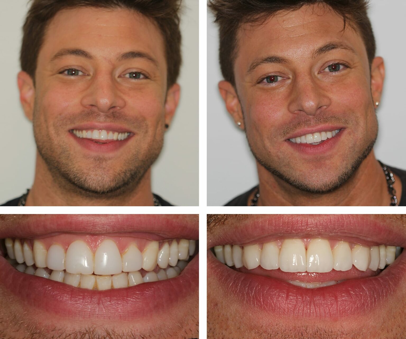 Duncan 8 upper porcelain veneers Central London W1, UK Harley