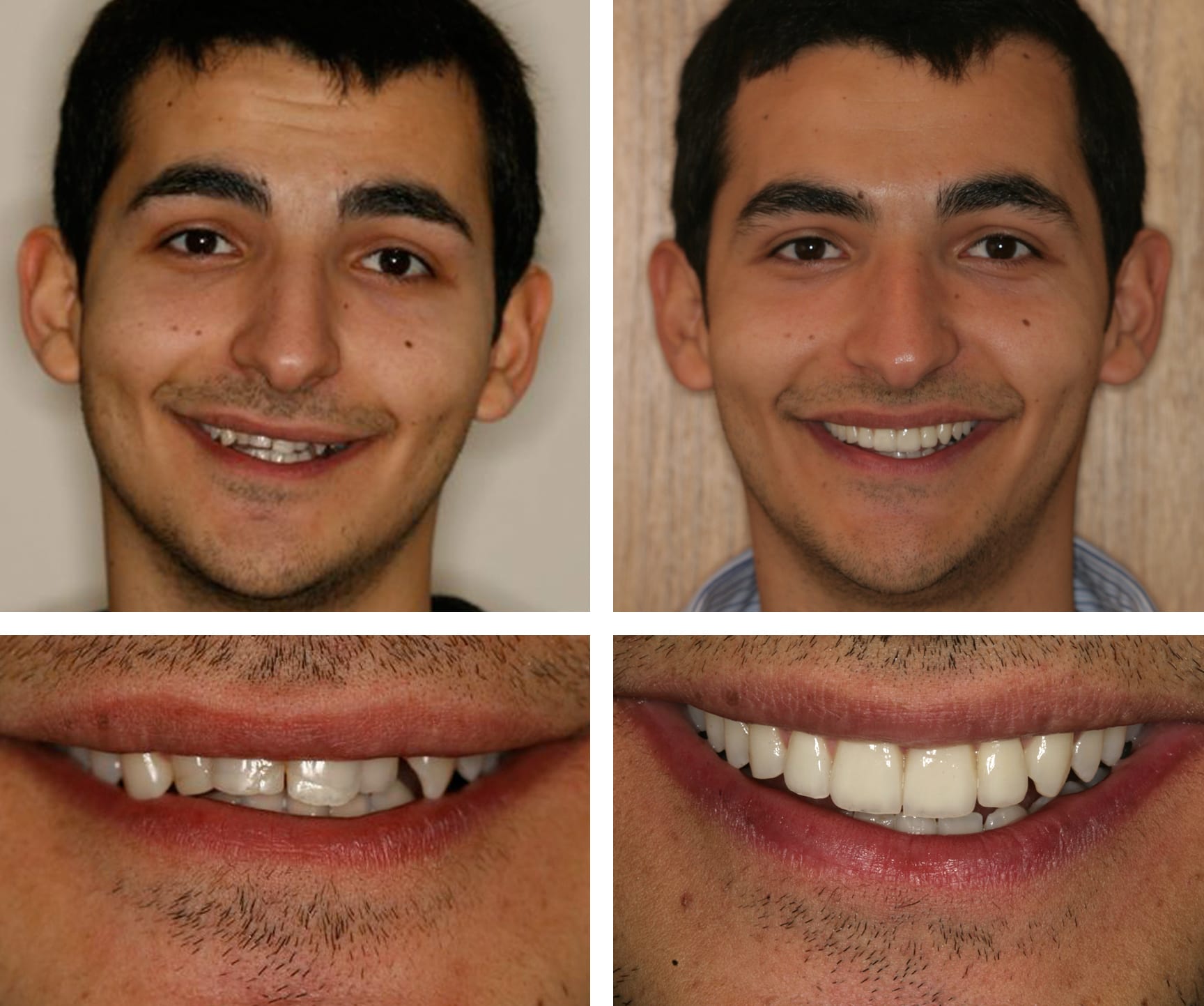 Implant Dentures - manfredi 1