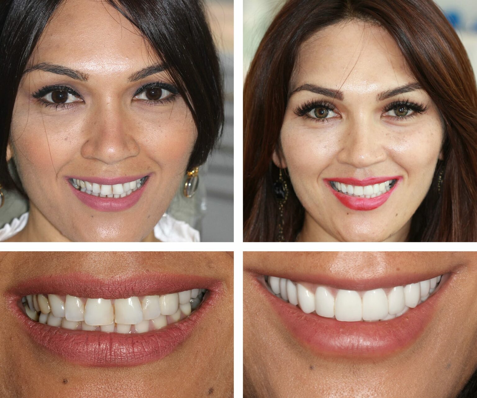 Composite Bonding & Veneers Central London W1, UK Harley Street