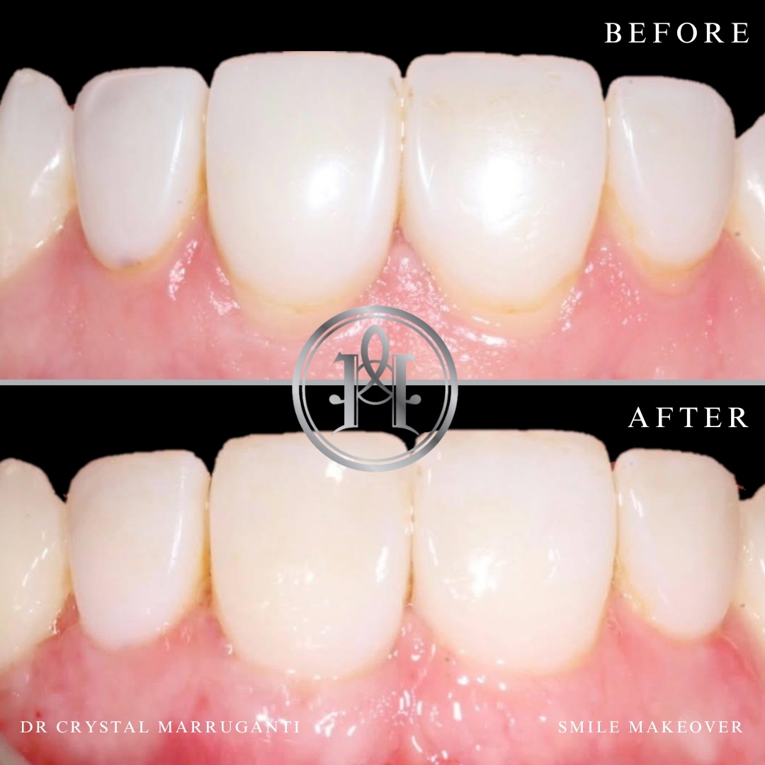Gum Grafting Case Study In London