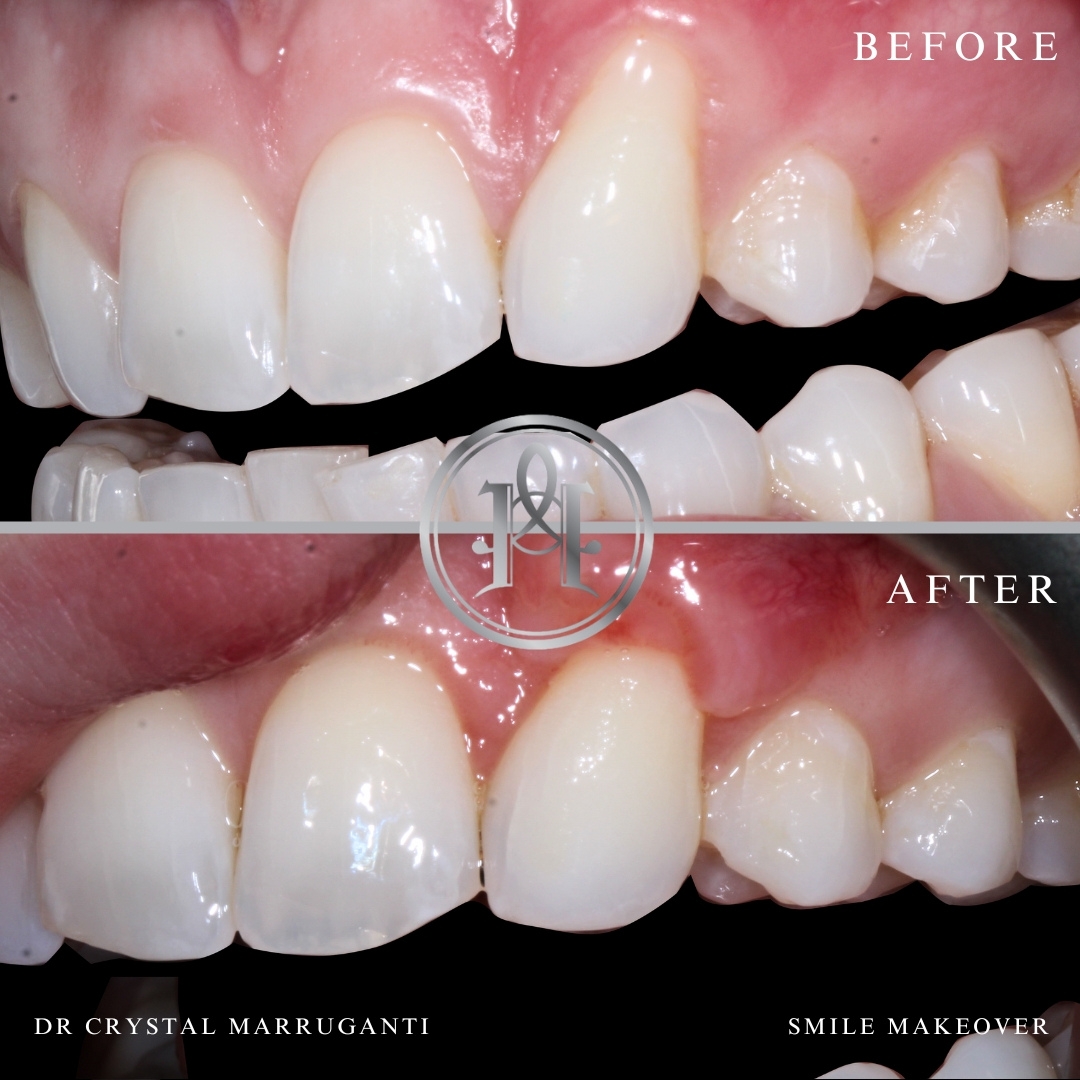 Gum Grafting Case Study In London