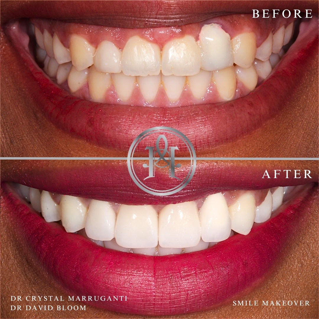 Gum Grafting Case Study In London