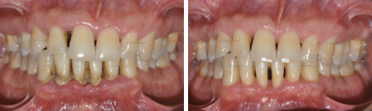 Gum Disease Case Study