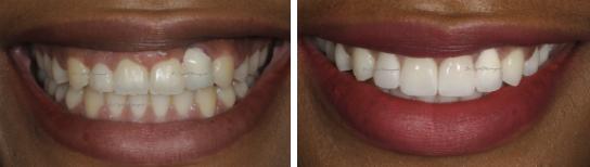 Gummy Smiles Case Study In London